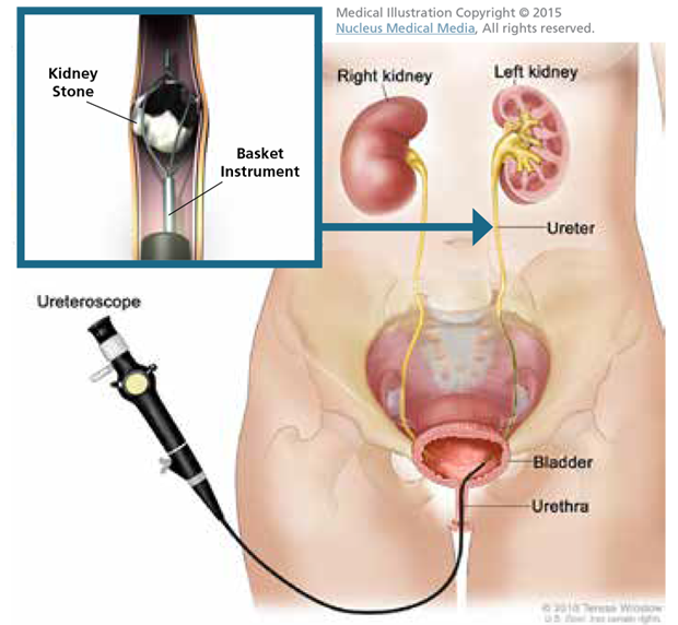 Best Kidney Stone Surgeon Surgery Panchkula Pkl Urologist In Haryana Panipat Karnal Solan Kalka Pinjore Parwanoo Himachal Pradesh Shimla Baddi Punjab