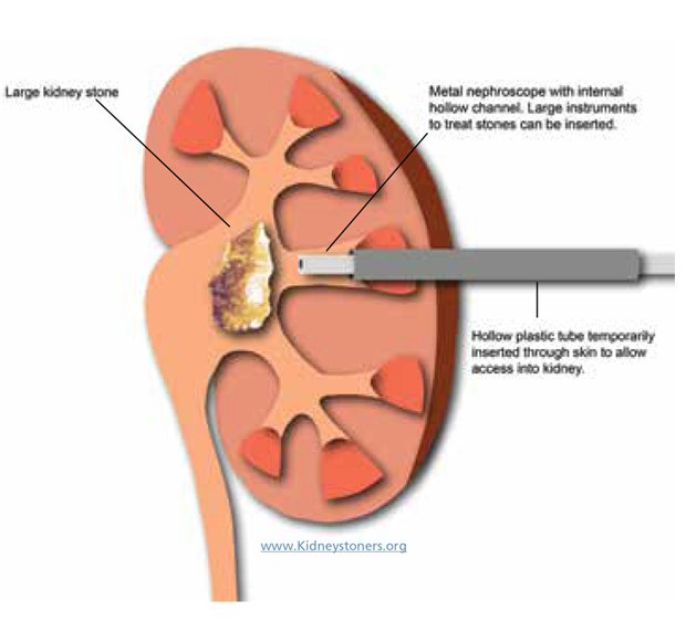 Best Kidney Transplant in Chandigarh