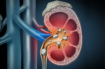 kidney-stones